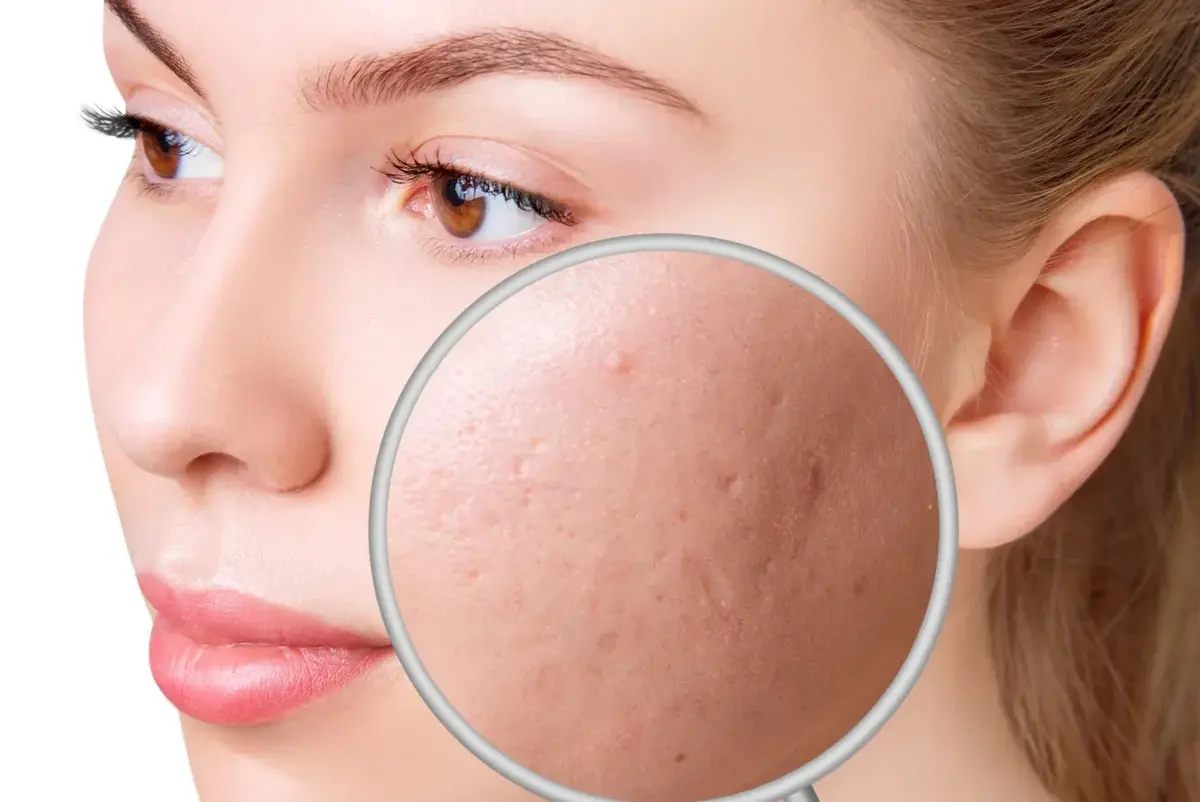 Acne & Acne Scars.webp